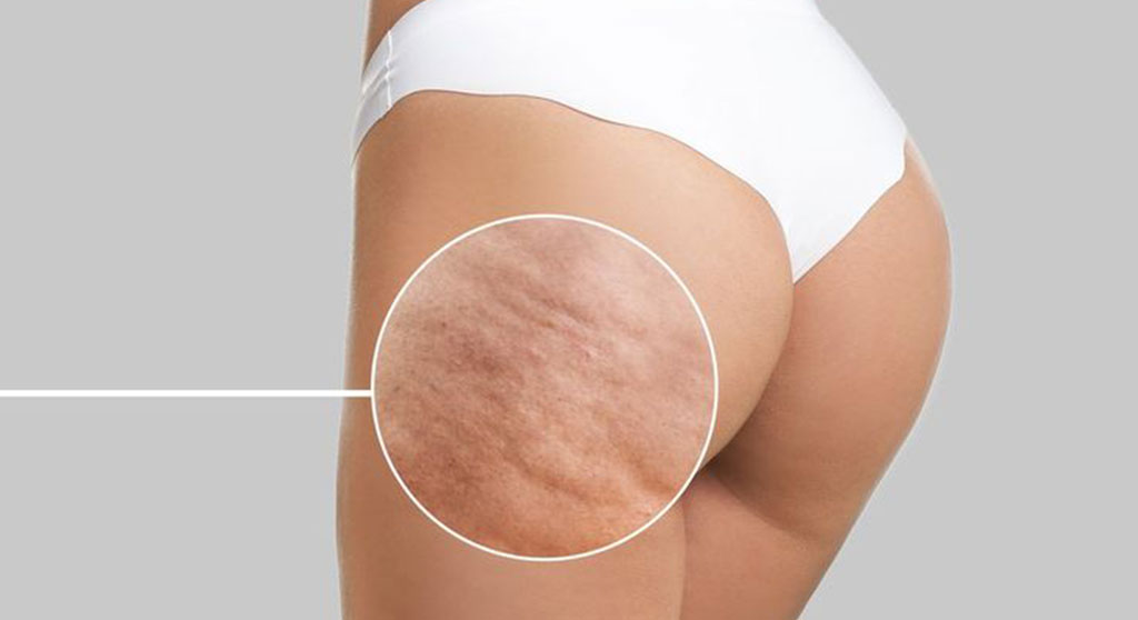 Piernas Ligeras y Sin Celulitis